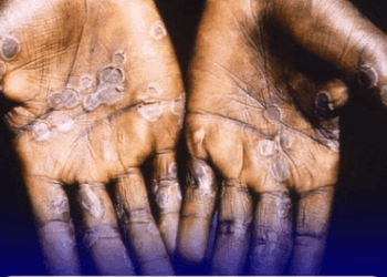 Mpox In East Africa
