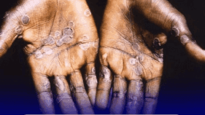Mpox In East Africa