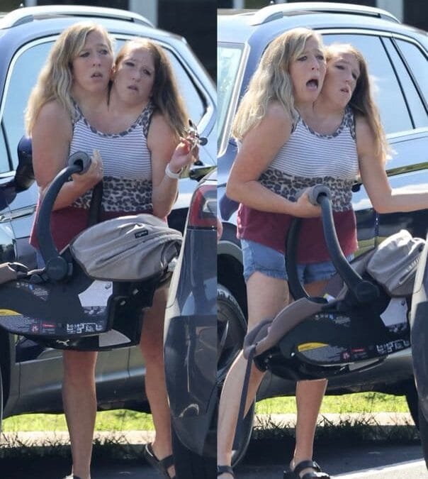Conjoined twins
