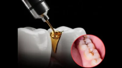 Broken teeth photo