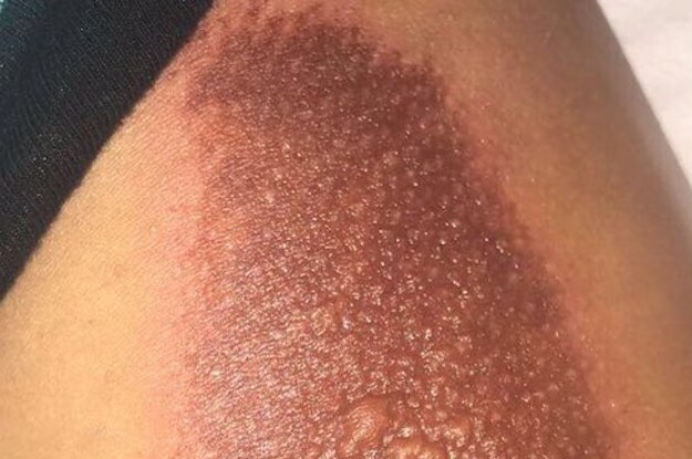 Bungoma Police hunting a man who burned daughter’s thighs, private parts with a hot iron